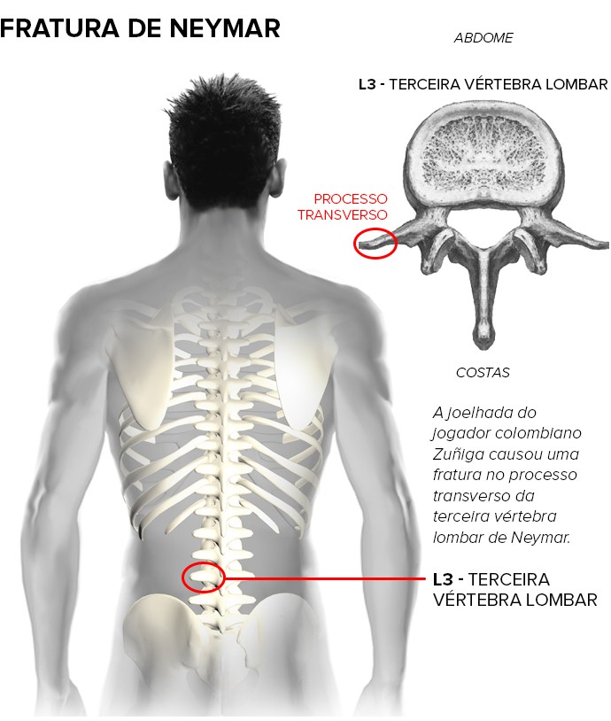 fratura neymar lado esquerdo (Foto: arte esporte)