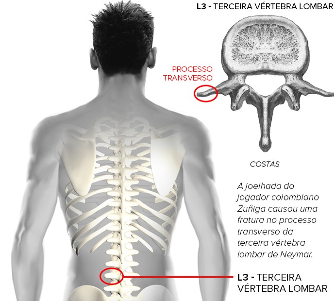 fratura neymar 2 (Foto: arte esporte)